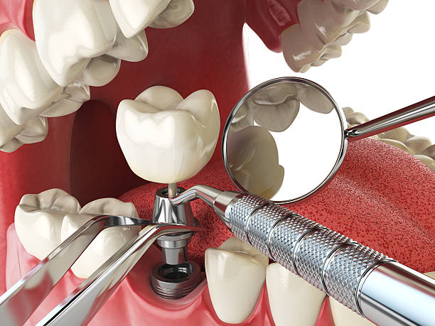 Best Emergency Root Canal Therapy in Underwood Petersville, AL